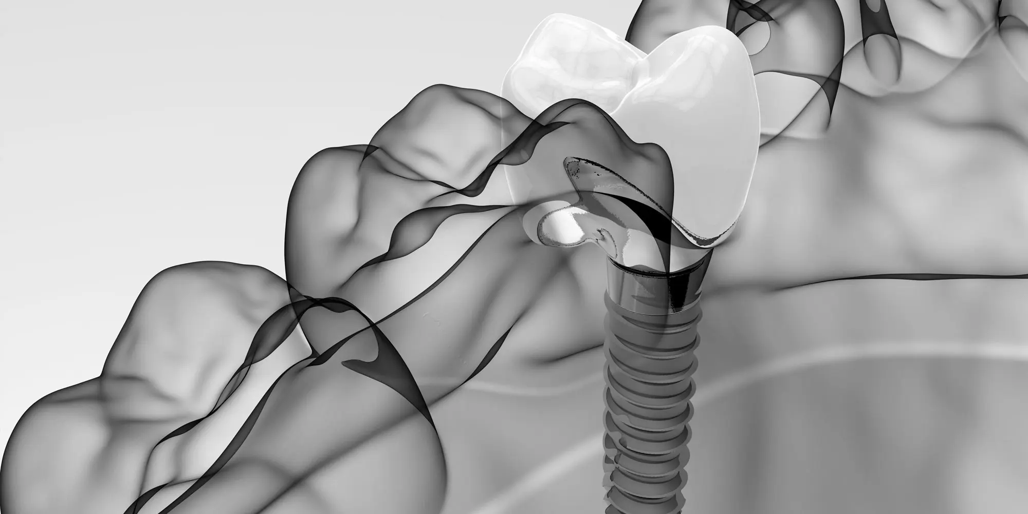 dental implant in ft lauderdale fl