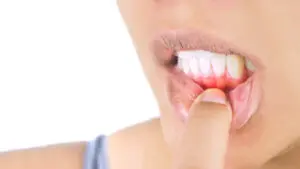 gum recession treatment