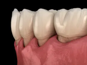 receding gums, pinhole surgical technique