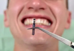 dental implant cost and expectants