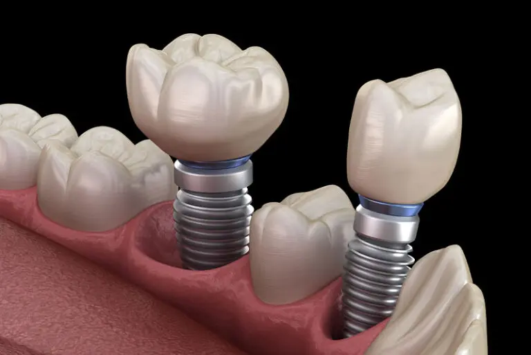 How A Dental Implant Looks In Your Mouth