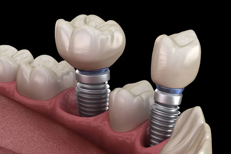 How A Dental Implant Looks In Your Mouth