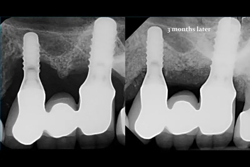 LAPIP® LASER PERI-IMPLANTITIS TREATMENT - FORT LAUDERDALE, FL