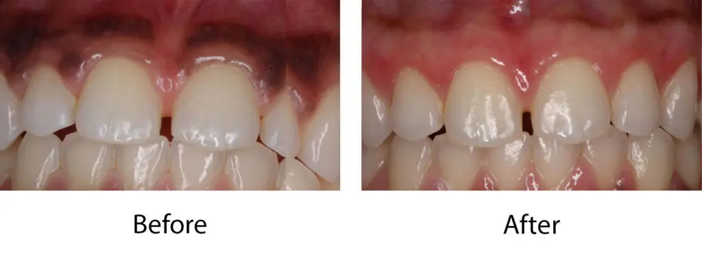 Laser Depigmentation