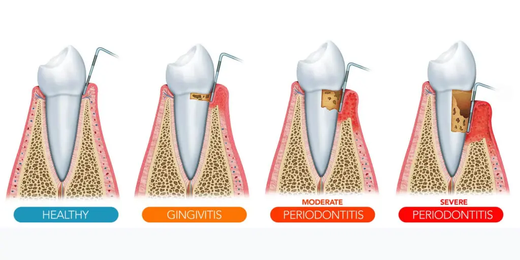 gum disease graphic