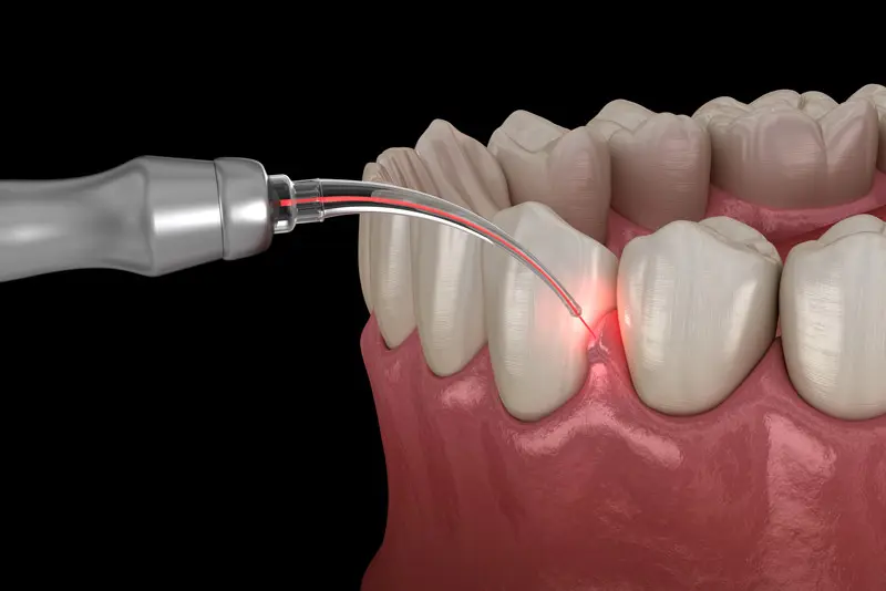 Example of laser dentistry.