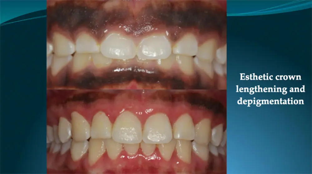 Before and after esthetic crown lengthening and depigmentation