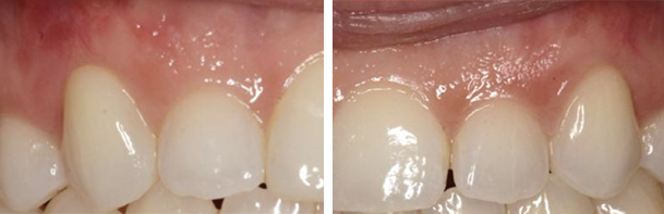 before and after pinhole surgery