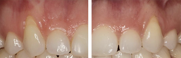 before and after pinhole surgery