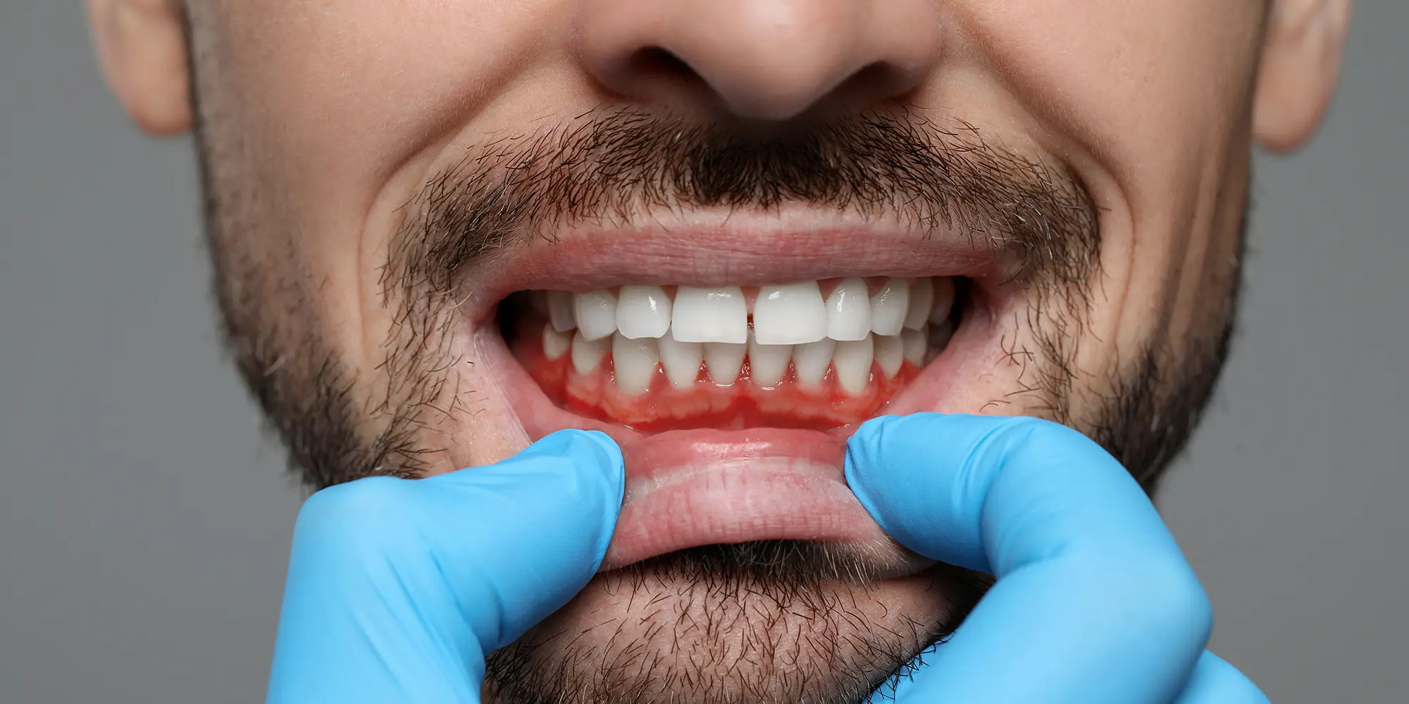 Periodontal Disease and Diabetes: A Two-Way Relationship