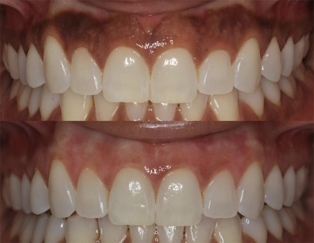 Before and after laser gum depigmentation
