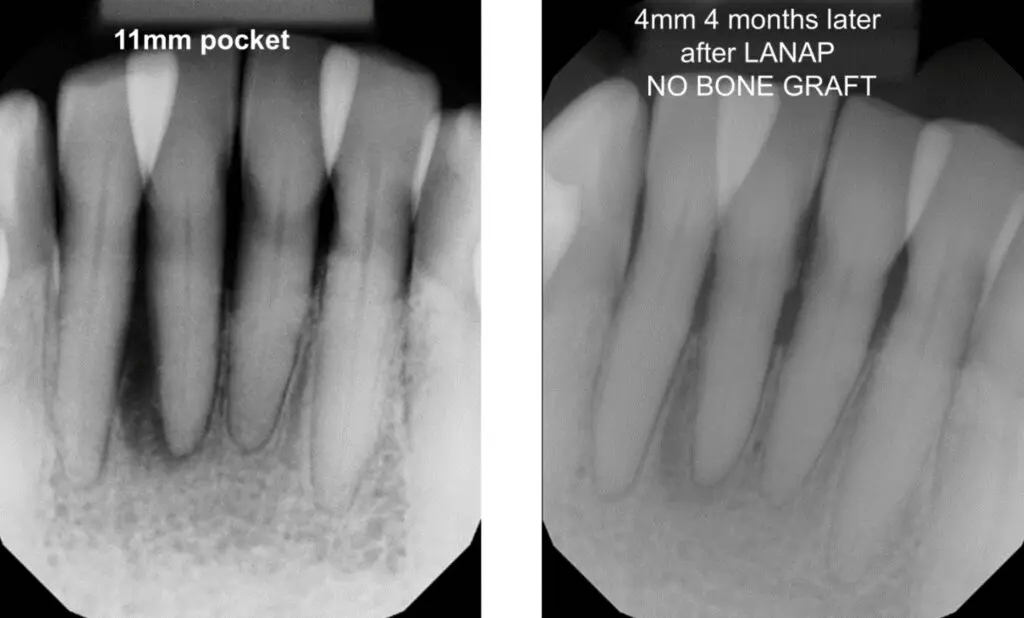 LANAP before and after pictures