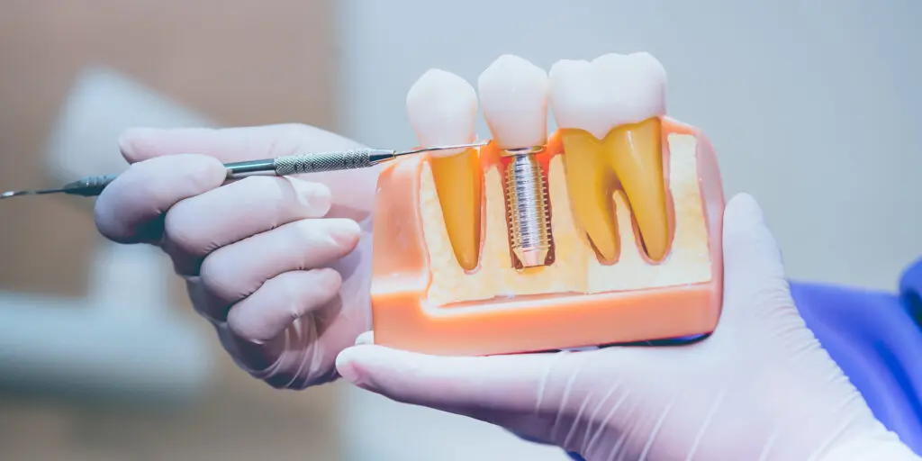 Parts of a Dental Implant: Understanding Each Component and Its Role