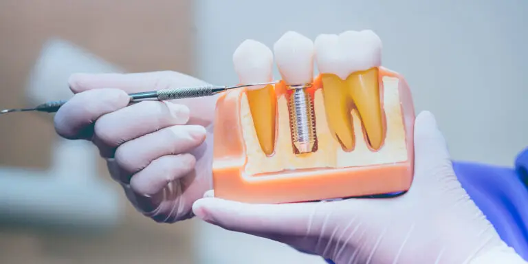 Parts of a Dental Implant: Understanding Each Component and Its Role
