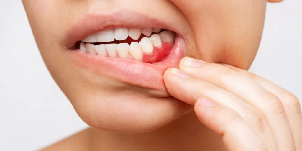 Why Are My Gums Bleeding? 6 Common Causes