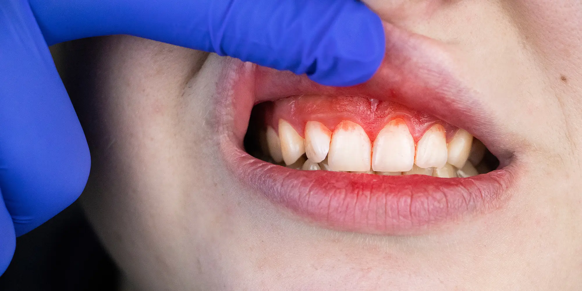 Gingivitis vs. Periodontitis: What's the Difference?