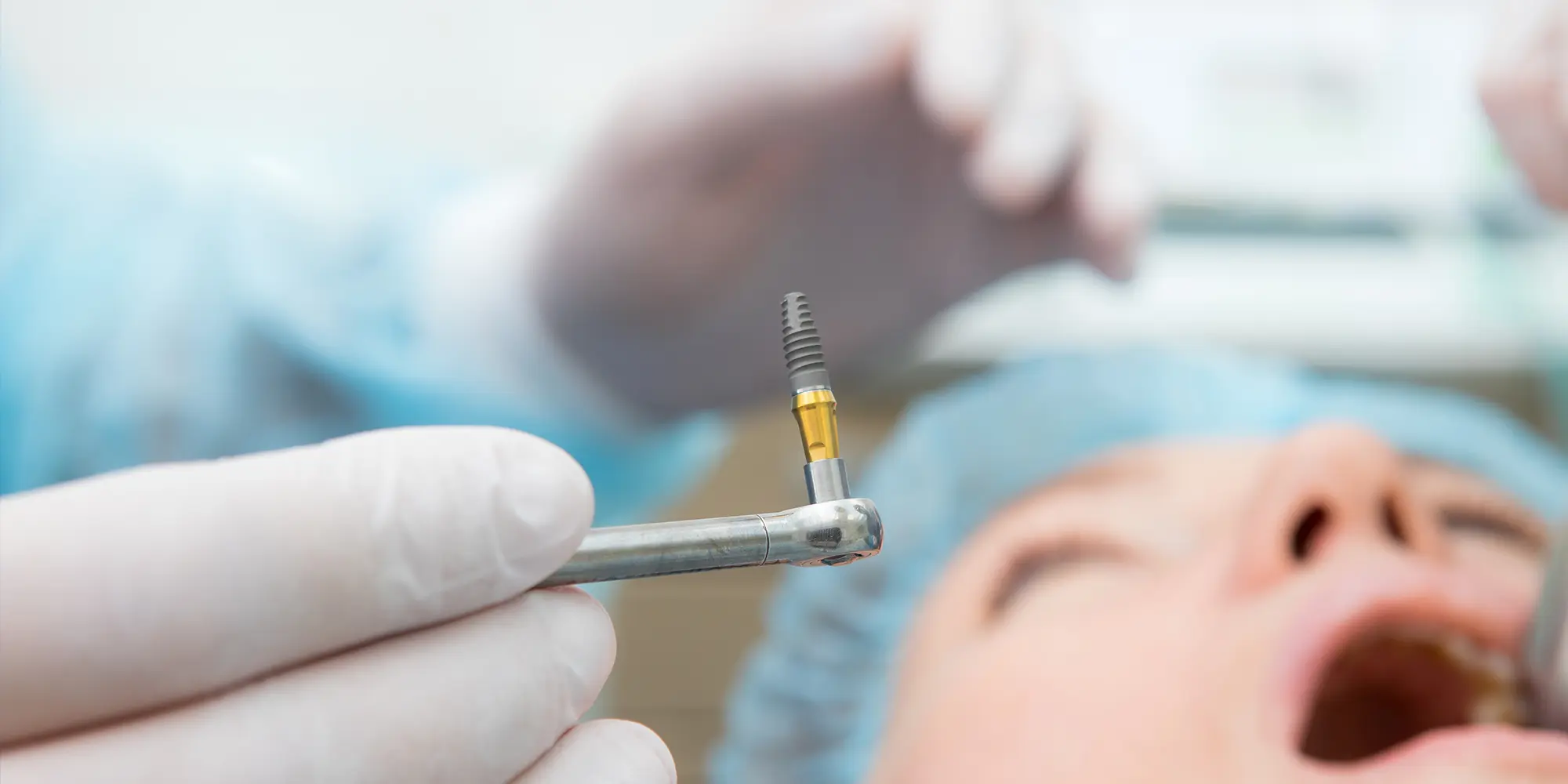 How Long Does a Dental Implant Procedure Take?