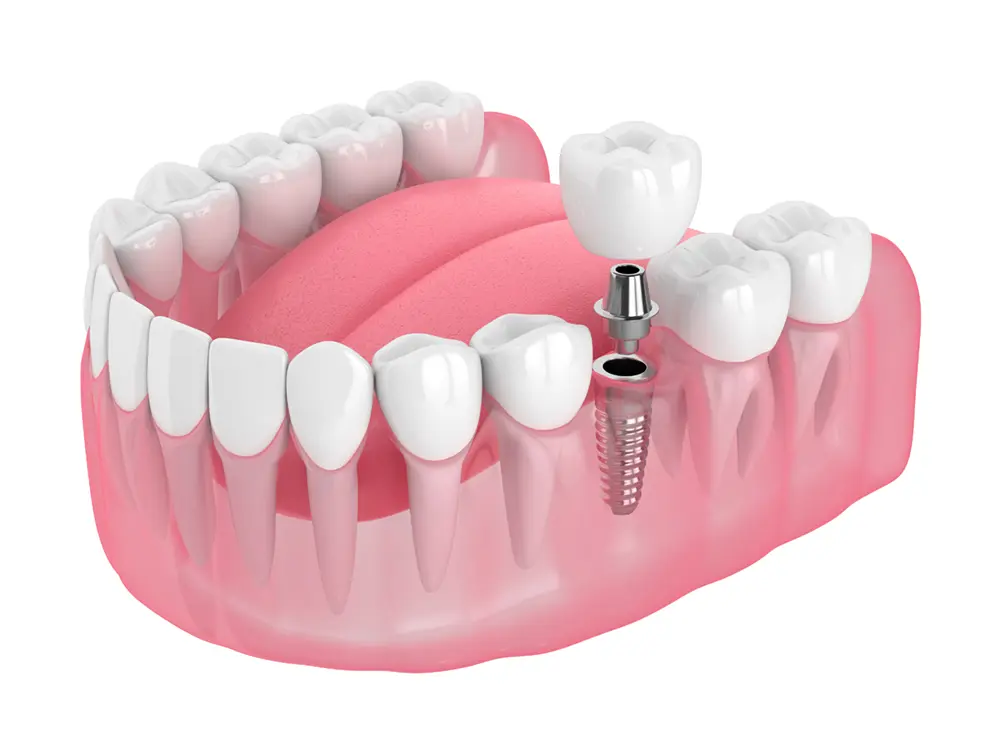 three parts of a dental implant