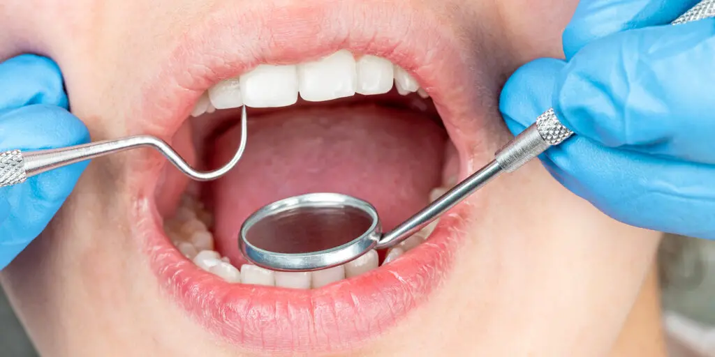 Periodontal Pockets Explained