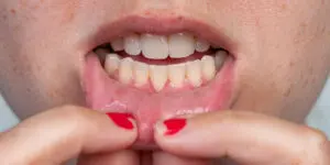 Can Receding Gums Grow Back?