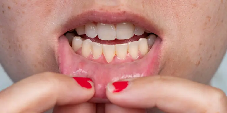 Can Receding Gums Grow Back?