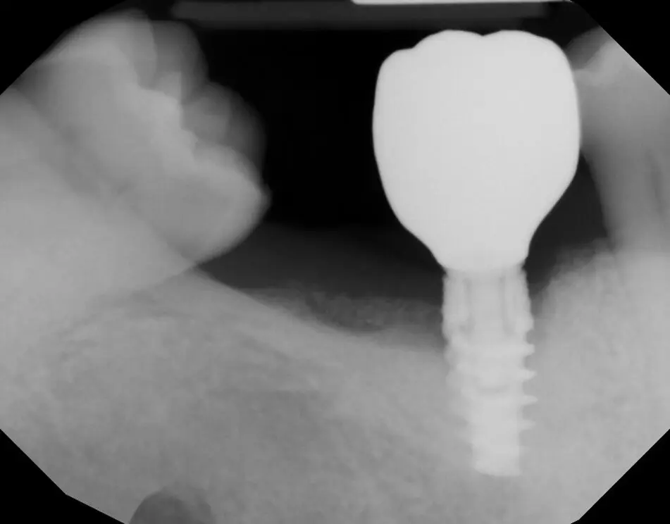 After LAPIP treatment