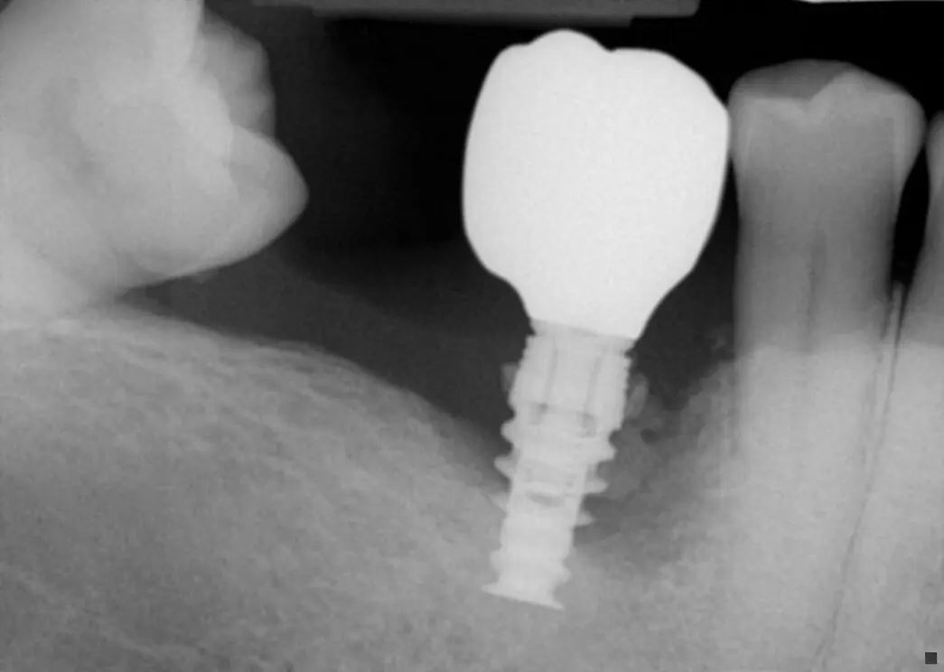 Before LAPIP treatment