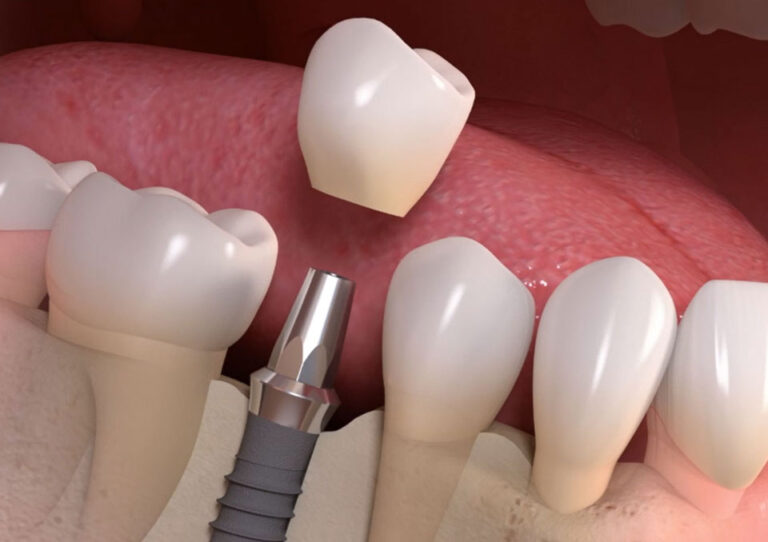 dental implant