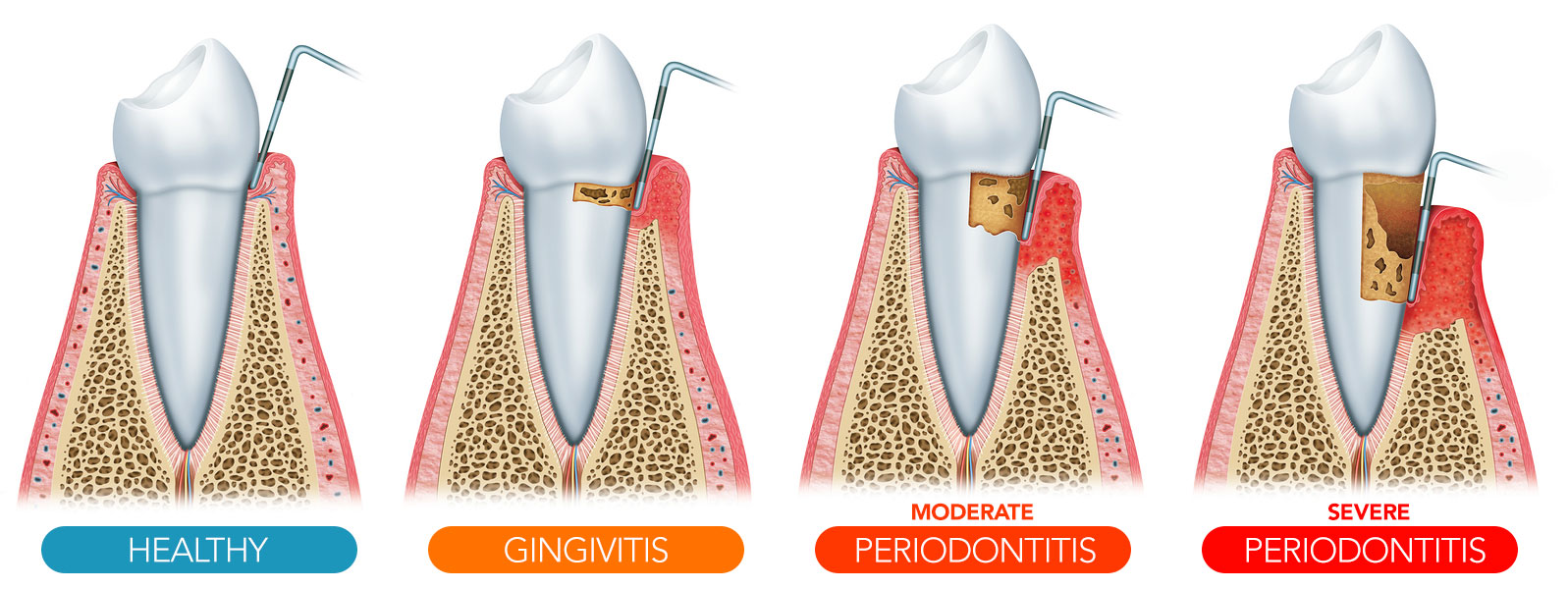Gum Disease Fort Lauderdale, FL