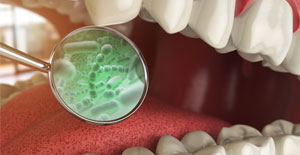 Gum Disease Fort Lauderdale, FL