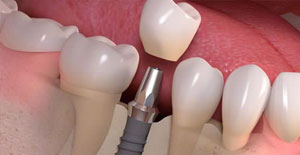Gum Disease Fort Lauderdale, FL