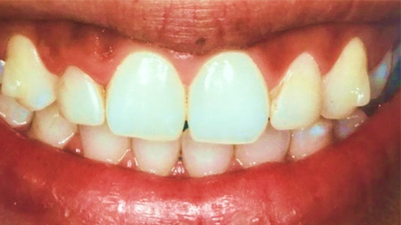 Laser Gum Depigmentation Fort Lauderdale, FL