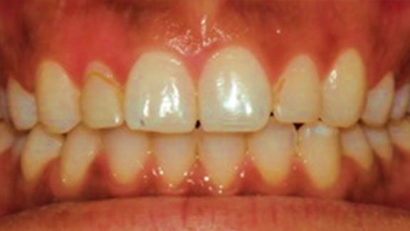 Laser Gum Depigmentation Fort Lauderdale, FL