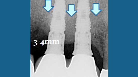 LaPIP® Laser Peri-implantitis Treatment Fort Lauderdale, FL