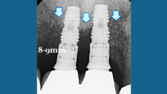 LaPIP® Laser Peri-implantitis Treatment Fort Lauderdale, FL
