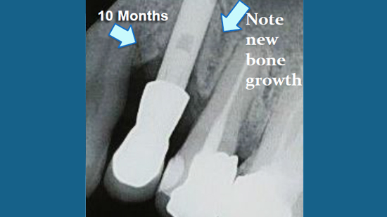 LaPIP® Laser Peri-implantitis Treatment Fort Lauderdale, FL