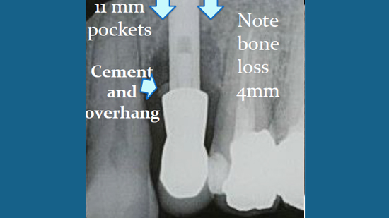 LaPIP® Laser Peri-implantitis Treatment Fort Lauderdale, FL