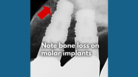 LaPIP® Laser Peri-implantitis Treatment Fort Lauderdale, FL
