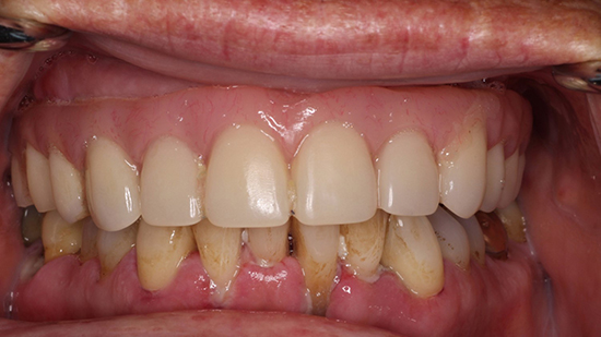 TeethToday® Dental Implants Fort Lauderdale, FL