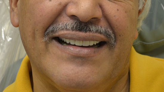 TeethToday® Dental Implants Fort Lauderdale, FL