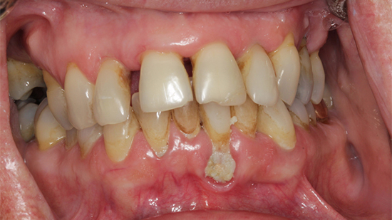 TeethToday® Dental Implants Fort Lauderdale, FL