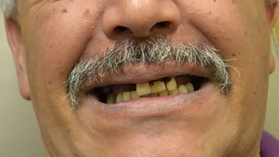 TeethToday® Dental Implants Fort Lauderdale, FL