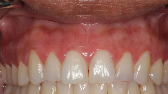 Laser Gum Depigmentation Fort Lauderdale, FL