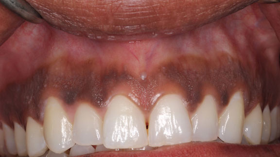 Laser Gum Depigmentation Fort Lauderdale, FL