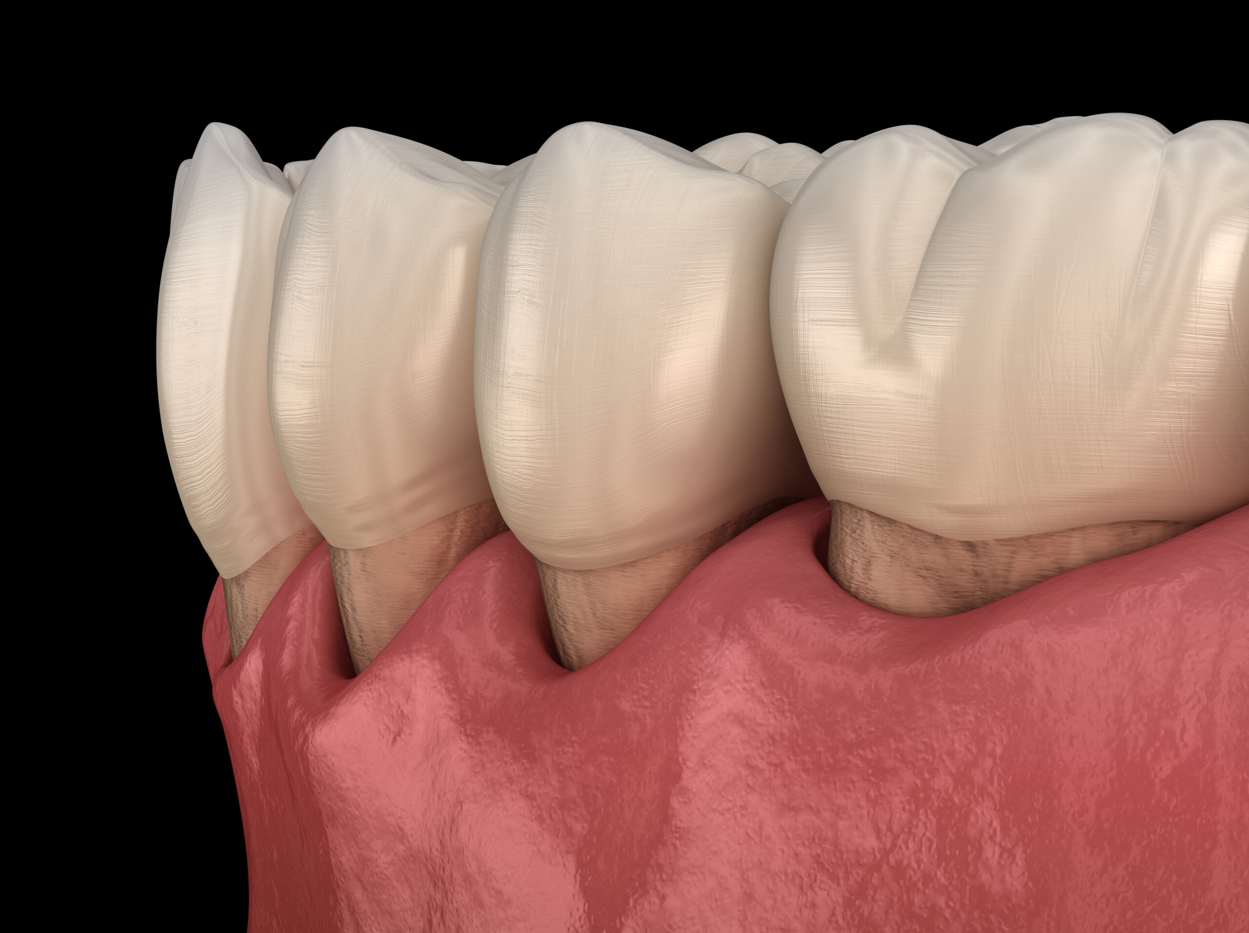 receding gums, pinhole surgical technique