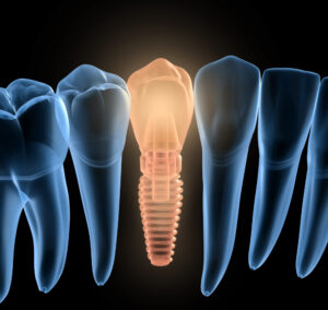 What Type of Anesthesia Will Be Used for My Dental Implants