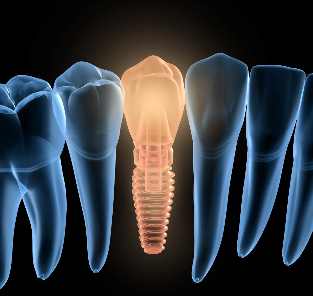 What Type of Anesthesia Will Be Used for My Dental Implants