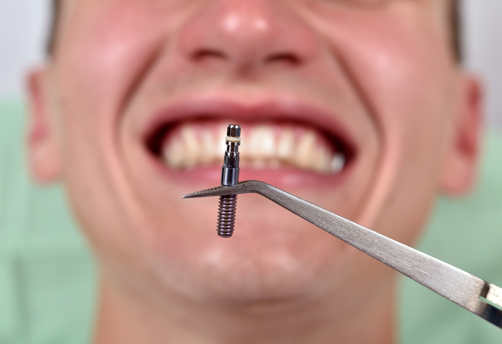 dental implant cost and expectants