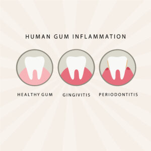 gum disease is preventable