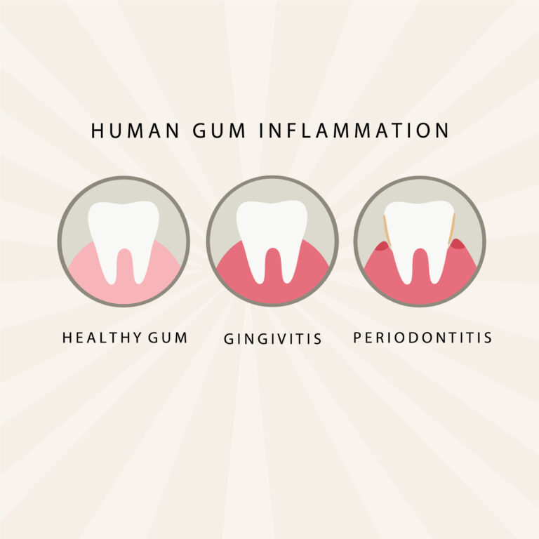 gum disease is preventable